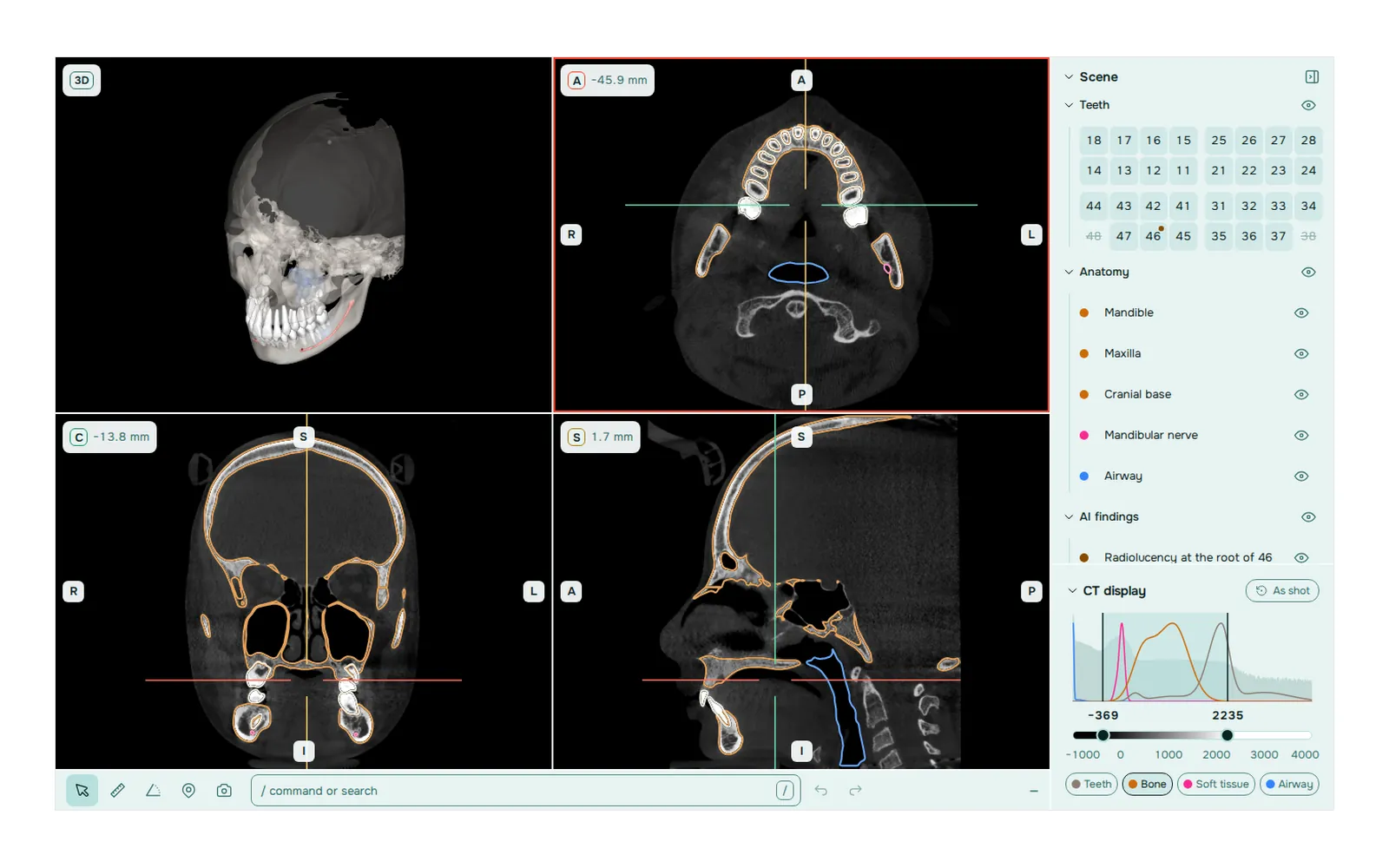 DentalMesh Studio: 3D view, three CBCT slices with segmentation and an FDI tooth chart